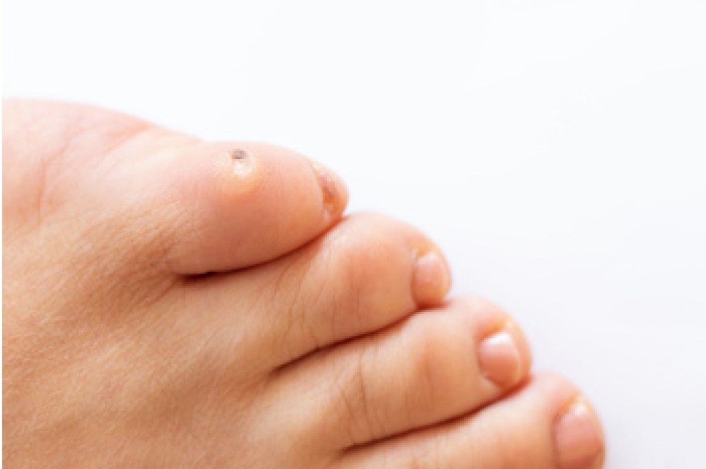 Understanding Foot Corns