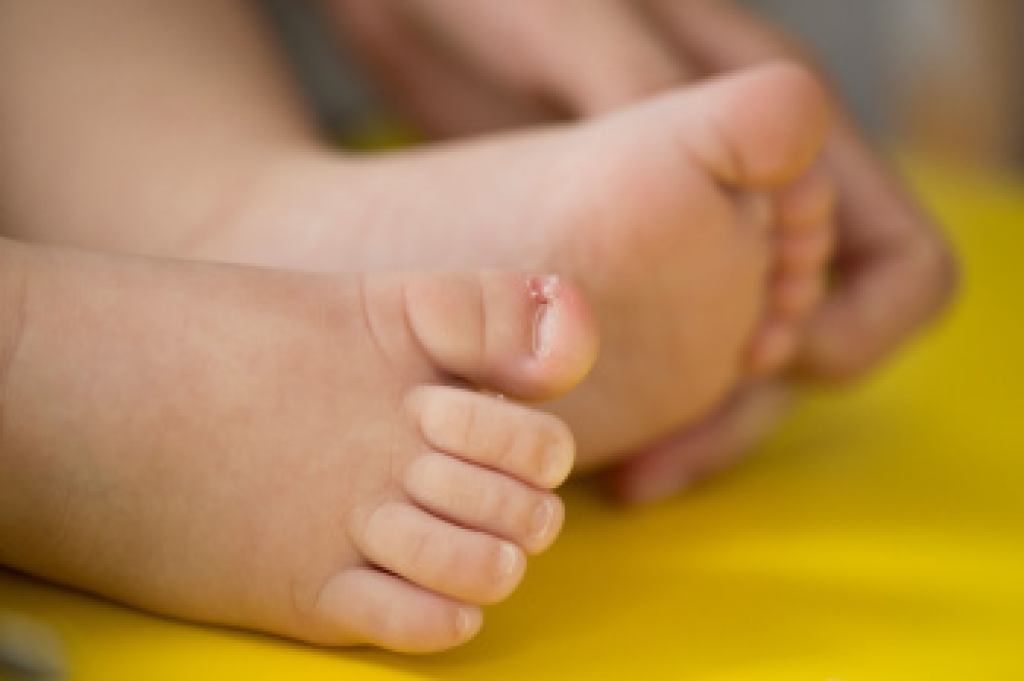 Causes of Ingrown Toenails in Babies