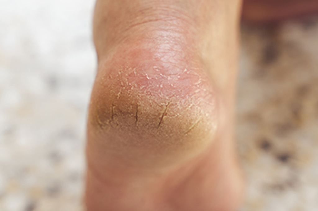 Skin That Hardens and Cracks