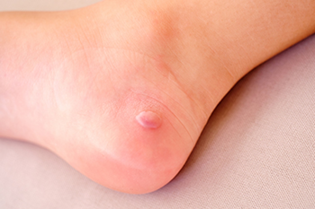 Podiatric Care for Blisters and Blistering Conditions