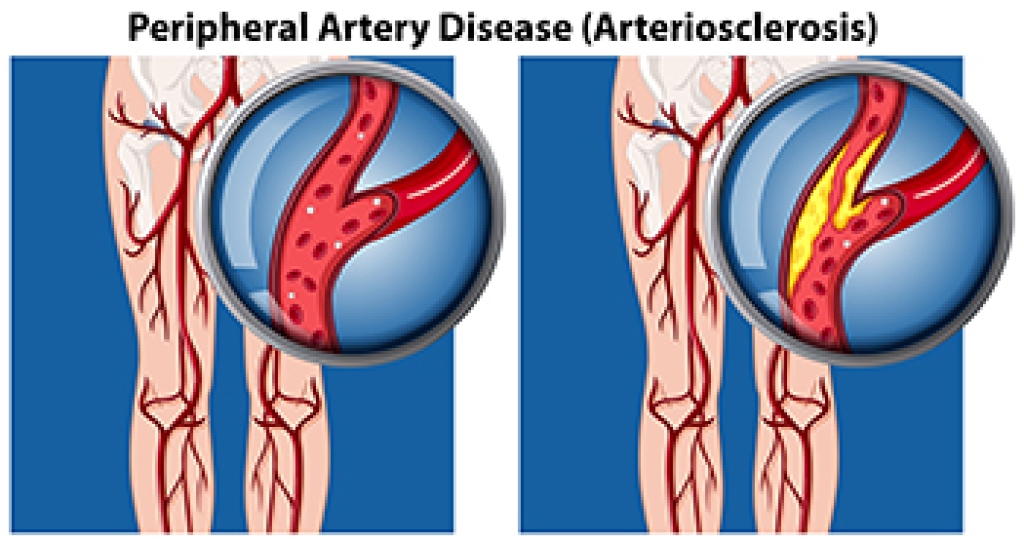 Peripheral Artery Disease and Foot Health