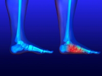 Are Fallen Arches and Flat Feet the Same Thing?