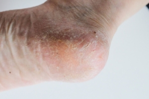 When Cracked Heels Are Beyond Unsightly