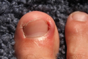 Can Ingrown Toenails Become Infected?