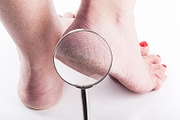 Extremely Dry Skin May Lead to Cracked Heels