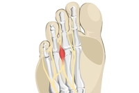 Foot Pain Management With Custom Orthotics