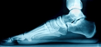 What Causes Flat Feet and How Can It Be Treated?
