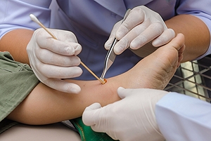 Neuropathy and Poor Circulation in Diabetic Feet