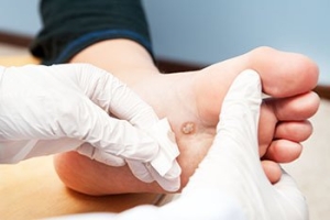 Do I Have a Wart on My Foot?