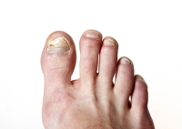 All About Toenail Fungus