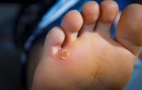 Protecting Your Feet from Plantar Warts at the Gym