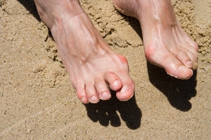 How Is Hammertoe Treated?
